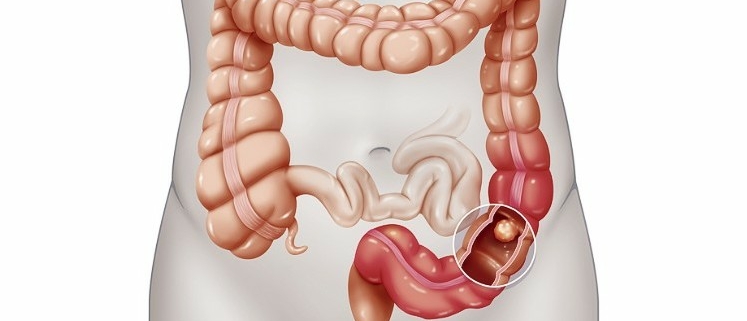 Colorectal Cancer