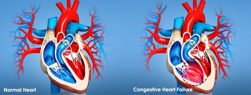 congenital-heart-disease